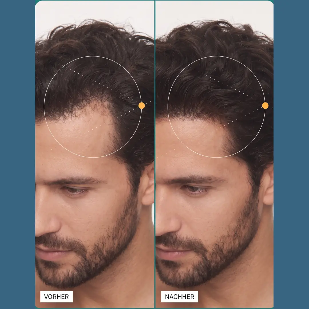ShinyHair - Follicle Support Complex - for men